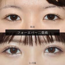 フォーエバー二重術1ヶ月後 美容クリニック 美容 埋没