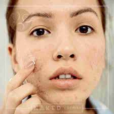 How To Treat And Prevent Acne Scars