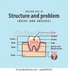 Decay And Abscess Cross Section Structure Inside Tooth Diagram And Chart Illustration Vector On Blue Background Dental Concept