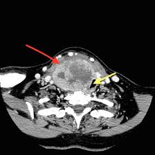 Medicare coverage includes a prescreening however, the lifetime risk of cancer from a single ct scan was small—about one case of cancer for. Anaplastic Thyroid Cancer Diagnosis
