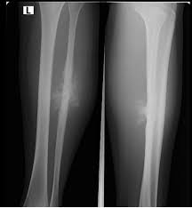 Osteosarcomas Are Malignant Bone Forming Tumours And The Second Most Common Primary Bone Tumour After Multiple Myeloma Radiology Radiology Imaging Radiography
