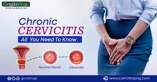 Image result for Acute Cervicitis
