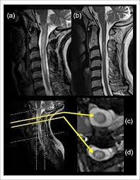 This inflammation can damage myelin, the fatty substance that covers your nerves. T2 Weighted Longitudinally Extensive Transverse Myelitis Letm Lesion Download Scientific Diagram