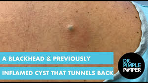 How to remove blackhead and whitehead by your hands ( squeeze ) 2018. Best Dr Pimple Popper Extraction Videos Popsugar Beauty