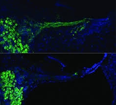 Bionic Ear Technology Used For Gene Therapy Neuroscience News Gene Therapy Cochlear Implant Deep Brain Stimulation