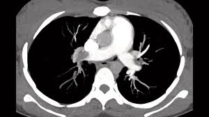 All other patients had ct pulmonary angiogram (ctpa). Pulmonary Embolism Diagnosis In Pregnancy How Bicetre Hospital Overcomes Imaging Challenges