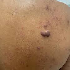 Image result for Keloid