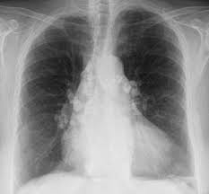 Pneumologie Unsere Krankheitsbilder Im Rontgenbild