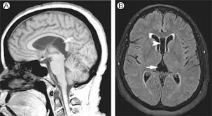 The Ventricular System Of The Brain Anatomy And Normal Variations Sciencedirect