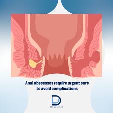 Image result for Intersphincteric Abscess