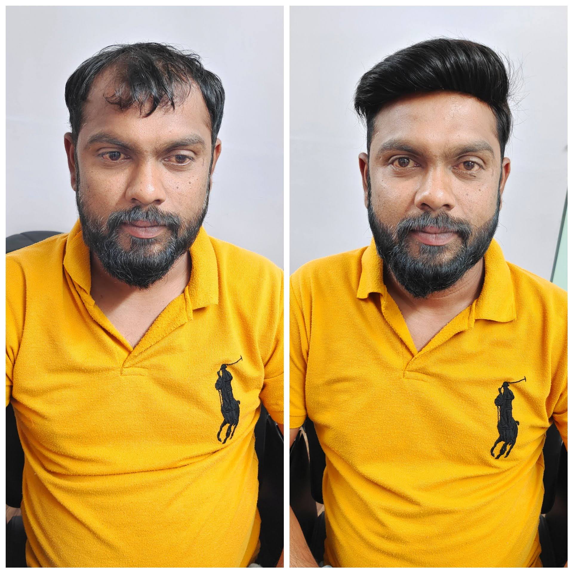 Hair Replacement Hair Patch Services product image