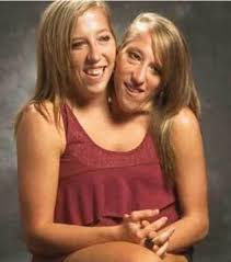 We would like to show you a description here but the site won't allow us. These Conjoined Twins Are Defying All Odds And We Are Loving It Illumeably