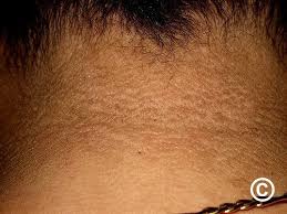 Image result for Diffuse Hyperpigmentation