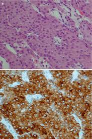 By grading you will have an idea. Mucoepidermoid Carcinoma Basicmedical Key