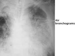 Image result for Air Bronchogram