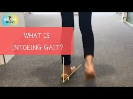 Image result for In-Toeing