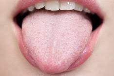 Da scharlach unter das so genannte infektion sschutzgesetz fällt muss jeder ausbruch gemeldet werden. Scharlach Infektion Die 15 Wichtigsten Fakten Fur Betroffene