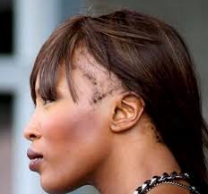 But not all guys need to shave their head to cope with a high hairline. 9 Ways To Save A Receding Hairline Bebe Akinboade