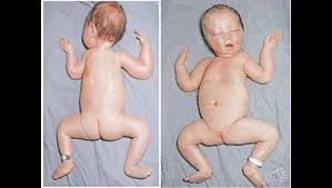 Image result for Floppy Infant