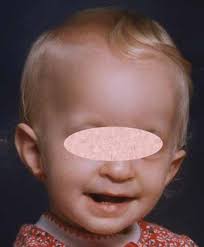 CASK-related intellectual disability: MedlinePlus Genetics