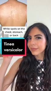 How to Treat and Remove White Spots