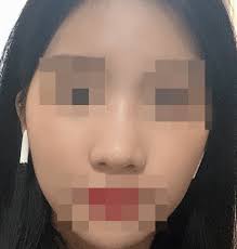 Rhinoplasty in Korea with Dr. Kim Hanjo, Eight Plastic Surgery :  r/SeoulPlasticSurgery