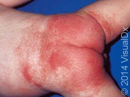 Image result for diaper dermatitis