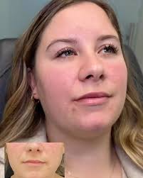 This lovely patient came in for lip filler to help disguise a scar in her  upper lip. The first video is immediately after injection and as you can  see, she is quite swollen. , The second video shows ...