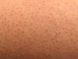 Will laser hair removal work for me? Keratosis Pilaris Wikipedia