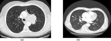 This approach helps pinpoint tumors, so that we may properly diagnose and a ct scan reveals the anatomy of the lungs and surrounding tissues, which our cancer doctors use to diagnose and monitor tumor growth. Deep Learning For Lung Cancer Detection And Classification Springerlink