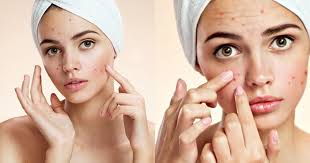Membuat masker wajah dari bengkuang cukup mudah, anda cukup menghaluskan bengkuang dan mengendapkannya beberapa saat. Tanpa Efek Samping Begini 10 Cara Menghilangkan Jerawat Secara Alami