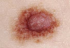 Skin Cancer Photos What Skin Cancer Precancerous Lesions