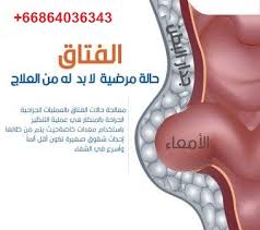 علاج الفتاق في تايلاند ربما يعتقد البعض أن مرض الفتاق يصيب الرجال فقط و خاصة الذين لا يفضلون إرتداء الملابس الداخلية إلا ان الحقيقة غير ذلك Thai Travel Trip