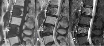 Le cancer colorectal est beaucoup plus fréquent dans les pays industrialisés. Metastasis Osea Cirugia De Columna En Matamoros