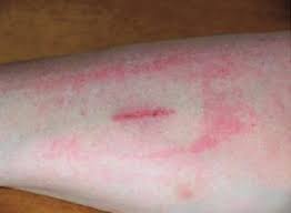 Image result for Skin Trauma