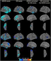Adhd brains are innovator brains. Distinct Brain Structure And Behavior Related To Adhd And Conduct Disorder Traits Molecular Psychiatry