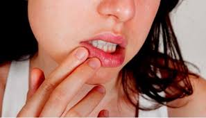 We did not find results for: 8 Obat Rumahan Untuk Atasi Sariawan Garam Hingga Minyak Kelapa Cantik Tempo Co