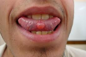 Mucocele What Is It Main Symptoms And Treatment Options Tua Saude