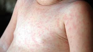Anstieg der infektionen wo das hantavirus lauert von lea wolz 05.06.2012, 19:40 uhr wer sich ansteckt, leidet unter grippeähnlichen symptomen: Krankheit Neuigkeiten Fotos Videos Seite 3