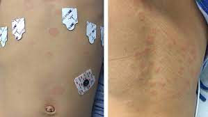 5,964 mh17 crash premium high res photos. Experts At Children S Hospital Of Philadelphia Describe Types Of Rashes Associated With Mis C Children S Hospital Of Philadelphia