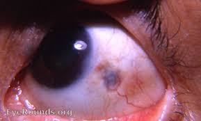 Image result for lesion sclera