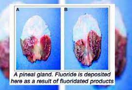 May 26, 2020 · researchers have identified that the pineal gland develops calcifications or calcium spots. Thread By Userdeebee 1 Hydroxychloroquine A Drug Used To Treat Malaria Among Others For The