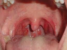 Un Test Para La Faringitis Aguda Uab Barcelona