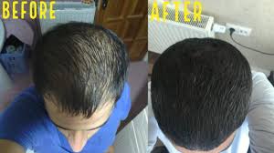 The results showed significant hair regrowth (microneedled areas were initially shaved) for most test pairs. Top 10 Microneedling Hair Growth Before After Results Youtube