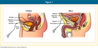 Image result for Urethral Catheterization