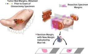 This means that in at least this area they got it. Improving Margin Revision Characterization Of Tumor Bed Margins In Early Oral Tongue Cancer Sciencedirect