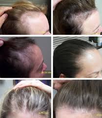 Check the label on the medicine for exact dosing instructions. Hair Loss From Stress Regrow