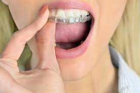 Check spelling or type a new query. Invisalign In Vallejo Ca Top Vallejo Invisalign Provider