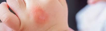 Image result for mosquito bite