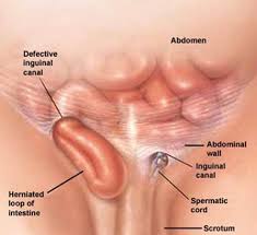 Image result for Inguinal hernia man